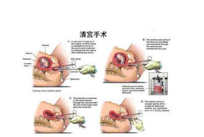 前沿科技力量重塑医疗格局，最新人流技术引领变革